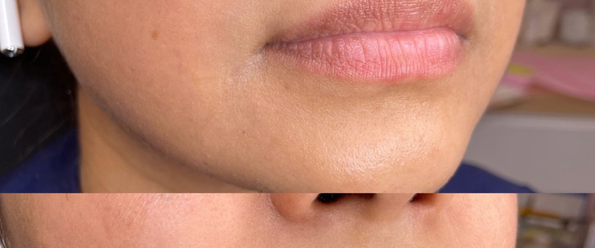 Why Medical Spas Use Medical Professional Networking To Ensure The Best Lip Filler Results For Patients In Las Vegas, NV?