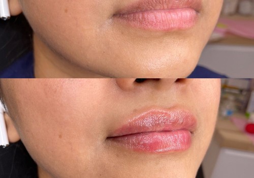 Why Medical Spas Use Medical Professional Networking To Ensure The Best Lip Filler Results For Patients In Las Vegas, NV?